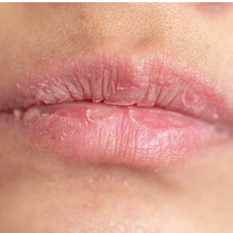 In pregnancy lips can become very chapped, cracked and dry.